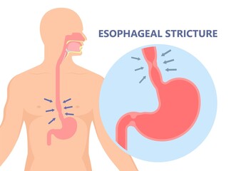 Dysphagia infection trachea examine Surgery choking gastric diagnose windpipe disorder bleeding surgical GERD treat tumor throat biopsy system ulcers stomach block eat food stuck test tract stent pain