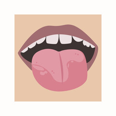 White spots on the tongue. Vector illustration of a child's mouth with a disease for dermatologists or dentists.