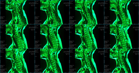 set of 6 sagittal green colored MRI scans of neck area of caucasian 34 years old male with...