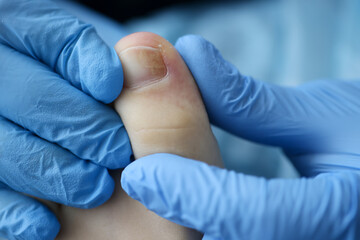 Doctor's hands in rubber gloves touch injured toenail in clinic closeup. Diagnosis and treatment of...