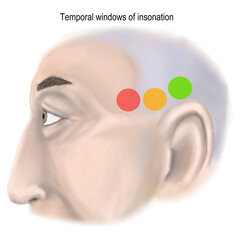 Anterior, middle and posterior temporal windows of transcranial Doppler sonography.