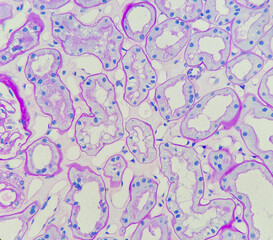 Proximal tubule reveals thickened basement membrane in diabetic patient, magnification 400x, photo under microscope