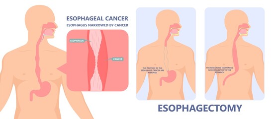 Dysphagia infection trachea examine Surgery choking gastric symptoms diagnose windpipe disorder bleeding surgical GERD treat tumor throat biopsy system ulcers stomach blocked eating food stuck test