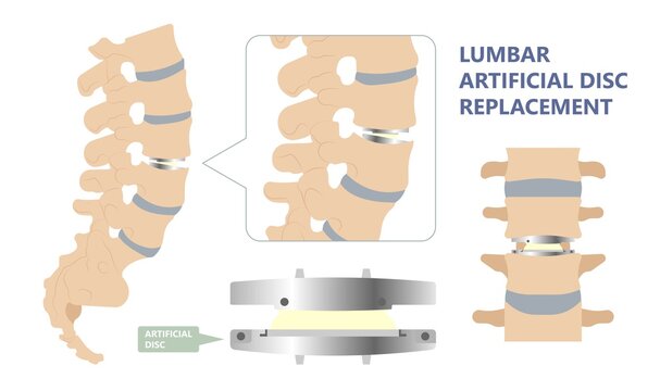 Artificial Disc for Treatment the Degenerative Disc Disease arthritis osteoarthritis spondylosis ankylosing spondylitis slipped