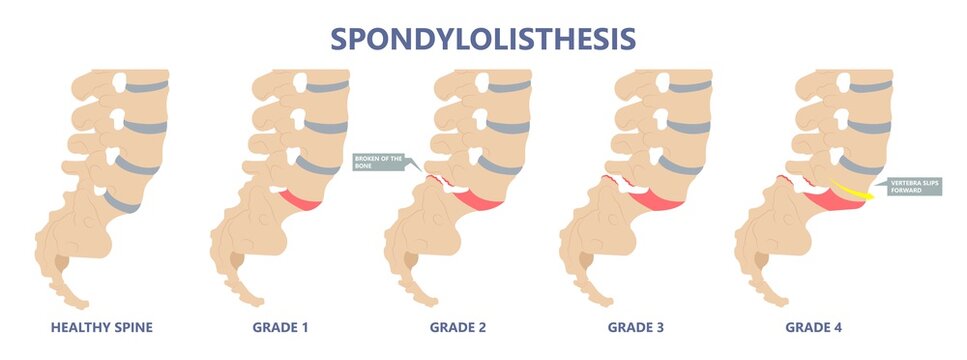 Spondylolisthesis a spinal disease that causes one of the lower vertebrae to slip forward disk hip pain bone birth defect injury sports accident exam nerve epidural steroid injections fusion leg