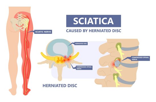 Sciatic nerve