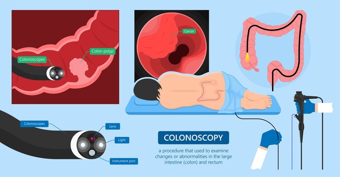 Polypectomy procedure to remove polyps from the colon medical