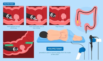 Polypectomy procedure to remove polyps from the colon medical