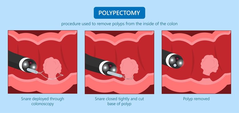 Polypectomy Procedure To Remove Polyps From The Colon Medical