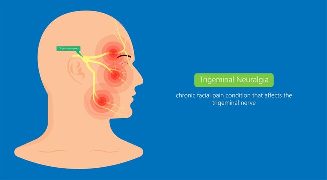 Trigeminal neuralgia chronic pain of facial TMD injury ophthalmic maxillary mandibular sensation central nervous system immune attacks myelin