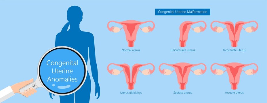 Abnormal uterus Tipped septum missed mature cervix double absent defect system period loss cycle birth labor short uterus female treat Risk type exam woman ducts Shape