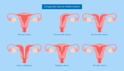 Abnormal uterus Tipped septum missed mature cervix double absent defect system period loss cycle birth labor short uterus female treat Risk type exam woman ducts Shape