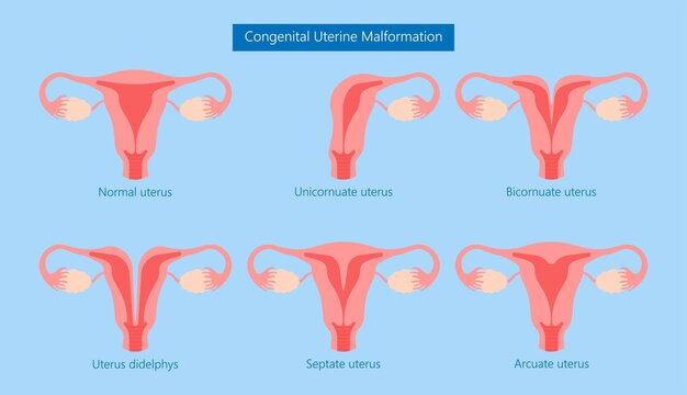 Abnormal uterus Tipped septum missed mature cervix double absent defect system period loss cycle birth labor short uterus female treat Risk type exam woman ducts Shape