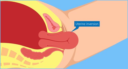Postpartum hemorrhage PPH care baby loss Prevent therapy problem vagina period Lochia mother uterus trauma previa atony labor blood women birth treat Risk