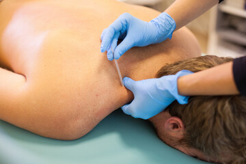 Obraz na płótnie Canvas Doctor sticks needle into man's body on the acupuncture