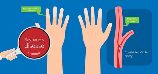 Raynaud's disease erythematosus Scleroderma buerger circulation paleness cold Injury numb vasospasm Carpal tunnel