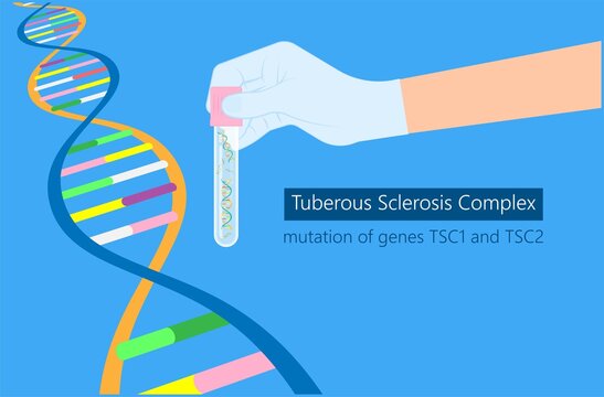 Tuberous Sclerosis Complex genetic disease symptoms aka Bourneville polycystic kidney