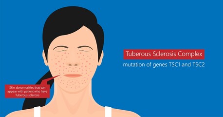 Tuberous Sclerosis Complex genetic disease symptoms aka Bourneville polycystic kidney