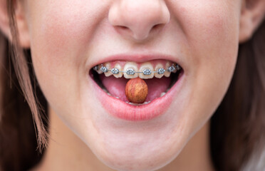 Girl in braces trying to crack an almond. Smile. Portrait