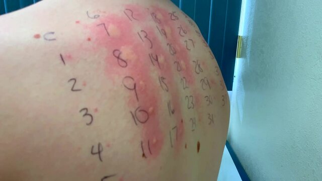 Allergy skin test on teen boy's back with inflammed allergic reactions, medical doctor's office, 4k dolly in- handheld