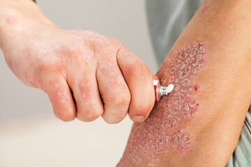 the use of emollient for dry flaky skin, as in the treatment of psoriasis, eczema and other diseases of dry skin.