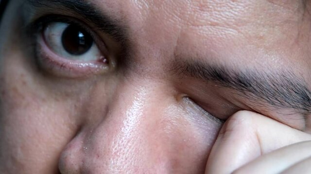 Asian men are rubbing their eyes due to dry eyes after working on a computer monitor or using a cell phone