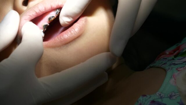 Dentist Examining Severe Tooth Decay in Child &ndash; Close-Up Pediatric Dental Checkup