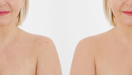 Close-up before after woman body skin isolated on white background. Middle age Anti aging and...
