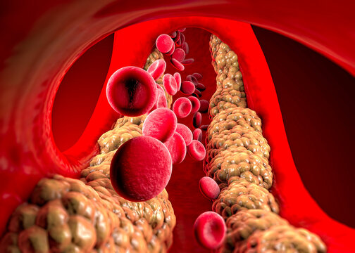 Cholesterol formation, fat, artery, vein, heart. Red blood cells, blood flow. Narrowing of a vein for fat formation. Surgery operation, 3d render
