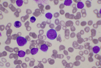 Moderate blast cell of white blood cells in blood smear.