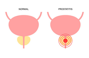 Prostatitis inflammation problem