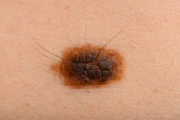 large nevus on the skin very close-up. A concept for preventing melanoma or removing moles and formations on the skin.