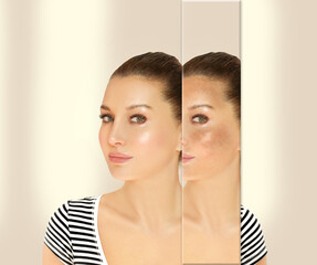 Dark spots, freckles,hyperpigmentation(melasma or chloasma),concept- skin lightening, skin whitening, Skin Brightening.