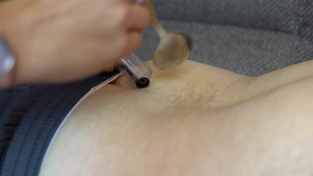 A leech is placed on the man's thigh. Treatment procedures