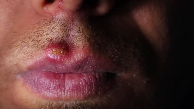 Herpes Simplex Virus (HSV) Mouth Infection.
herpes simplex virus type 1.
herpes simplex labialis.
fever, infectious disease. 
Herpes labialis.
cold sores.
Human alphaherpesvirus 1.
viral infections