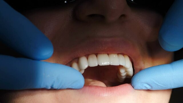 Dental and teethcare care concept. process of installing veneers. Veneers setting in modern dentistry. Close-up shot of female patient in chair having porcelain veneers installation procedure, 4 k