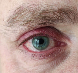 Close up of annoyed red blood eyes of male affected by Viral blepharitis, conjunctivitis or after...