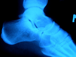 X-ray of the foot, heel. Scan, medical snapshot. Leg pain and treatment.
