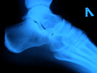Xray of the foot, heel. Scan, medical snapshot. Leg pain and treatment.