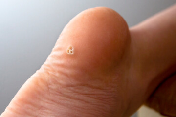 female foot with dry callus on the heel