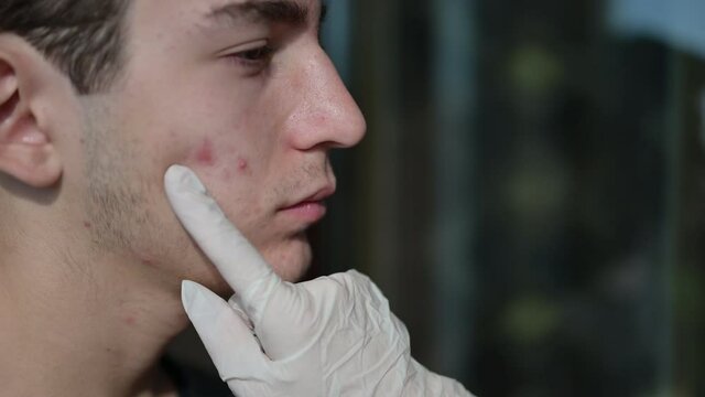  Close up shot of the face of a Caucasian boy in puberty as a hand with a latex glove examines the skin, focusing on boils and red dots.