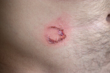 Blunt trauma to abdomen. Injury was caused by blow to abdomen with metal pipe. Biker was injured in...