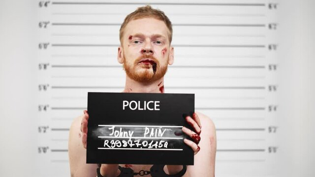 Young man with wounds on face holding signboard with cuffed hands posing for mugshot