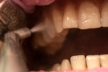 Closeup of teeth sandblasting