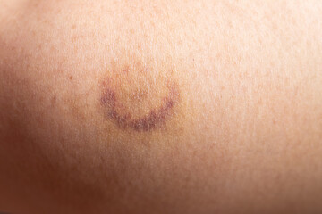 Closed up background of bruise wound on wound woman leg skin - obrazy, fototapety, plakaty
