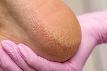 Fototapeta premium Male hardware pedicure in the salon. Photo series. First part: cracked and dirty foot and heel before treatment.