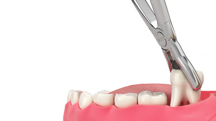 tooth clamped in medical extraction forceps dental services concept 3d render on white
