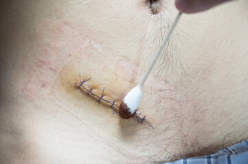 Nurse or Doctor hand treating the wound patient to clean the wound after stitches patients...