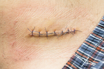 Nurse or Doctor hand treating the wound patient to clean the wound after stitches patients appendectomy surgery.
