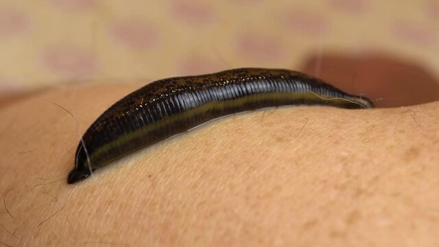 Medical leech on the human body drink blood. Treatment with leeches. Macro video.